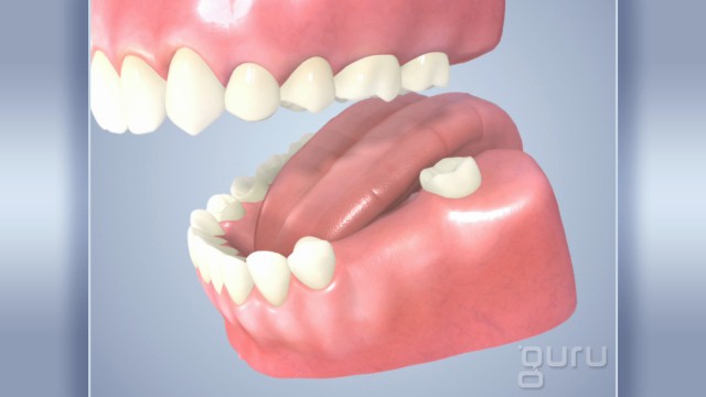 Partial Denture vs Implant